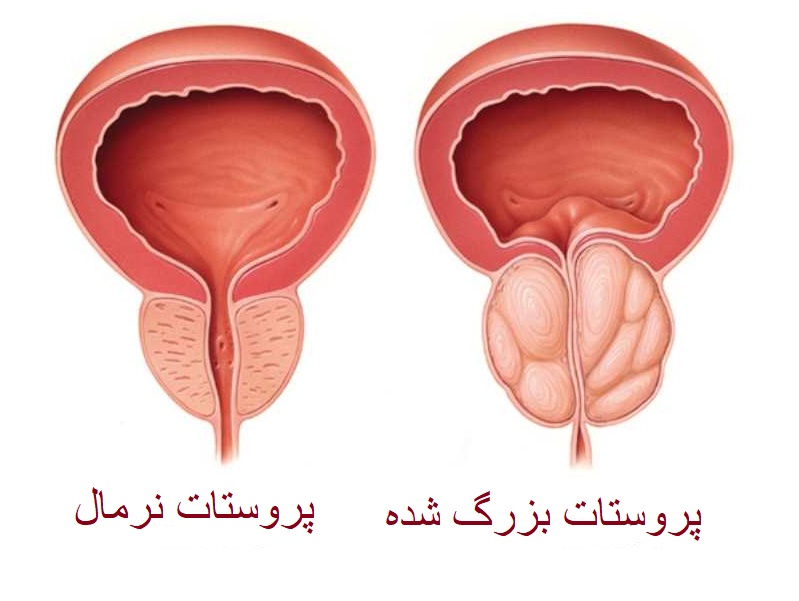 پروستات